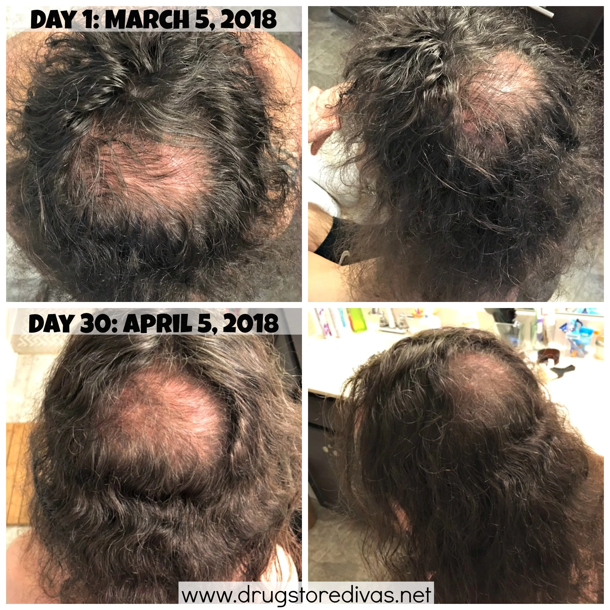 Hair loss can definitely be embarrassing. Take control of the situation with the iRestore Laser Hair Growth System. Get an honest iRestore review AND how to get $150 off at www.drugstoredivas.net.
