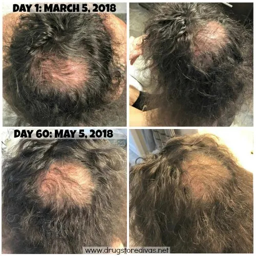 Hair loss can definitely be embarrassing. Take control of the situation with the iRestore Laser Hair Growth System. Get an honest iRestore review AND how to get $150 off at www.drugstoredivas.net.