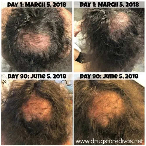 #ad Dealing with hair loss? Check out this iRestore Anti-Hair Loss Serum review on www.drugstoredivas.net.