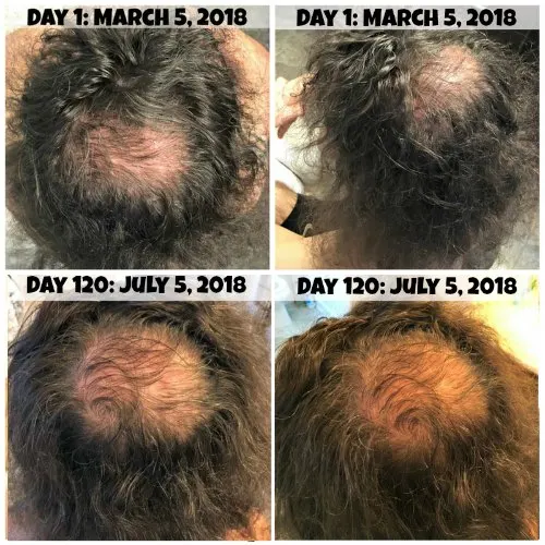 Hair loss can definitely be embarrassing. Take control of the situation with the iRestore Laser Hair Growth System. Get an honest iRestore review AND how to get $150 off at www.drugstoredivas.net.