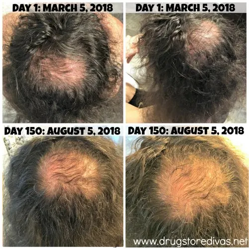 Hair loss can definitely be embarrassing. Take control of the situation with the iRestore Laser Hair Growth System. Get an honest iRestore review AND how to get $150 off at www.drugstoredivas.net.