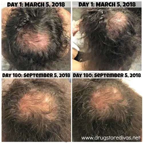 Hair loss can definitely be embarrassing. Take control of the situation with the iRestore Laser Hair Growth System. Get an honest iRestore review AND how to get $150 off at www.drugstoredivas.net.